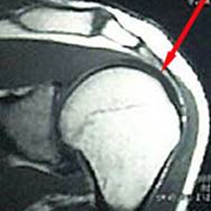 Kernspintomographie (MRI) der Schulter: intakte Sehne